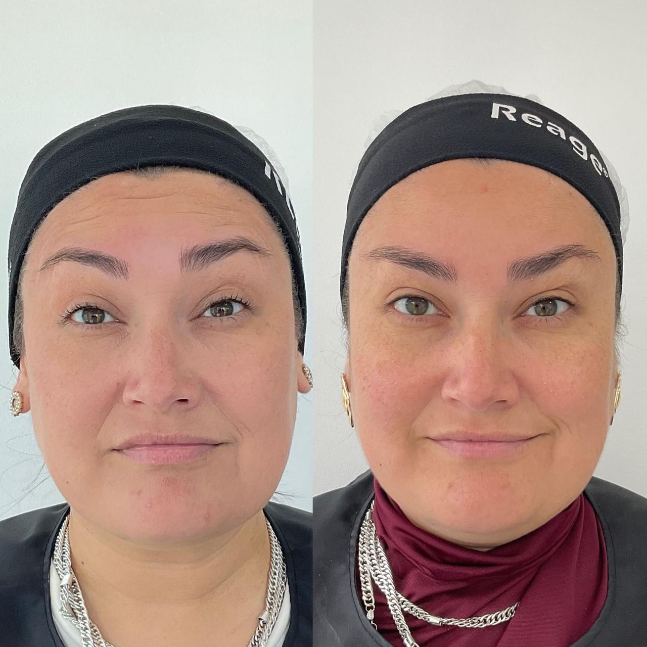 Antes y después de un paciente de Clínica Visage, caso 5