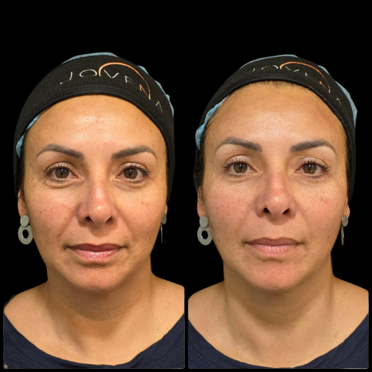Antes y después de un paciente de Clínica Visage, caso 4