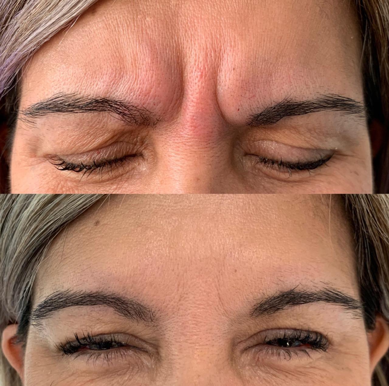 Antes y después de un paciente de Clínica Visage, caso 11