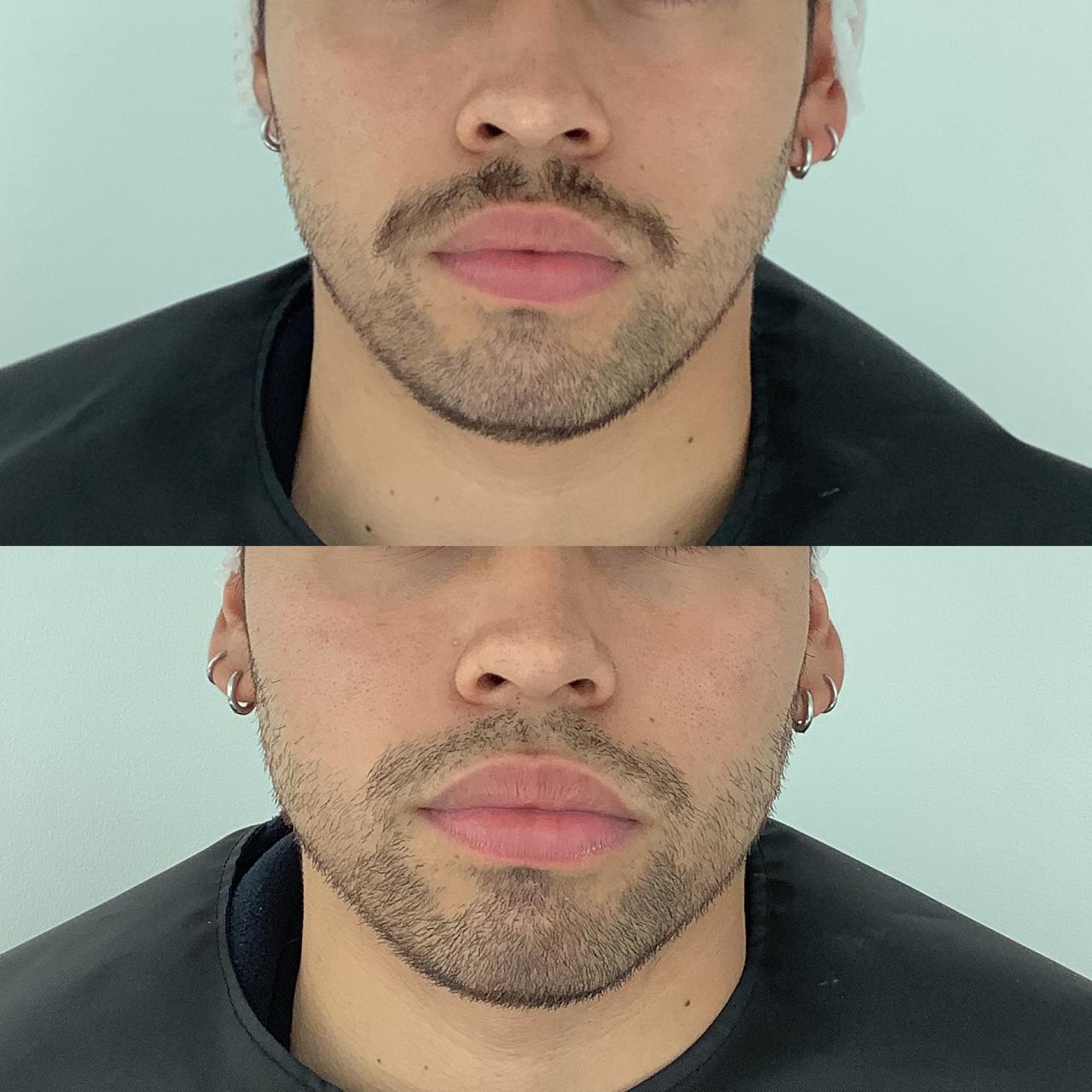 Antes y después de un paciente de Clínica Visage, caso 9