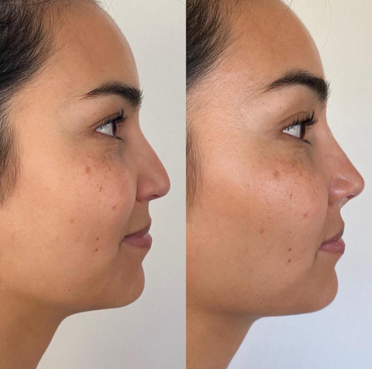 Antes y después de un paciente de Clínica Visage, caso 8
