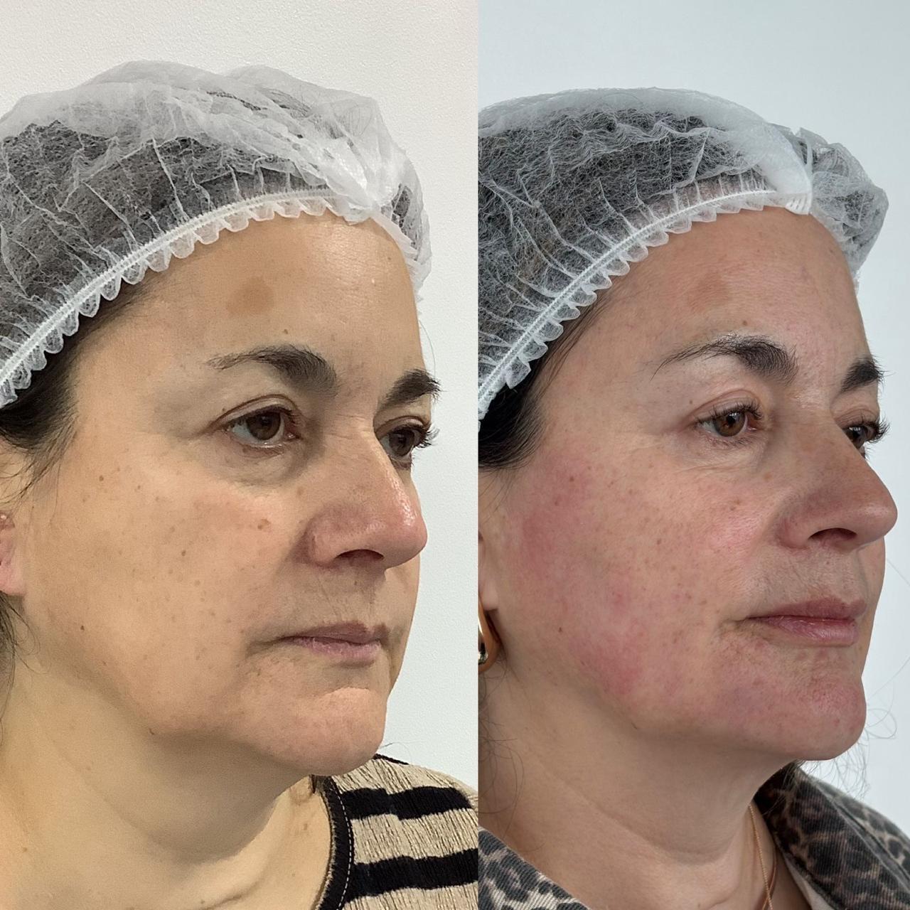 Antes y después de un paciente de Clínica Visage, caso 7
