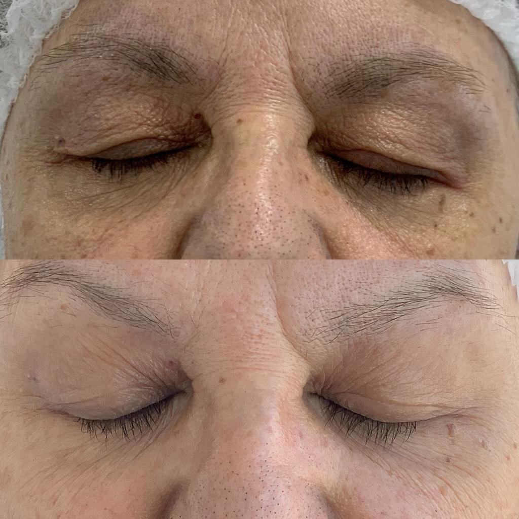 Antes y después de un paciente de Clínica Visage, caso 10