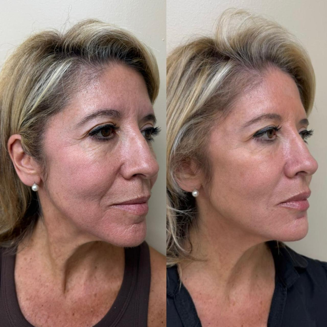 Antes y después de un paciente de Clínica Visage, caso 6