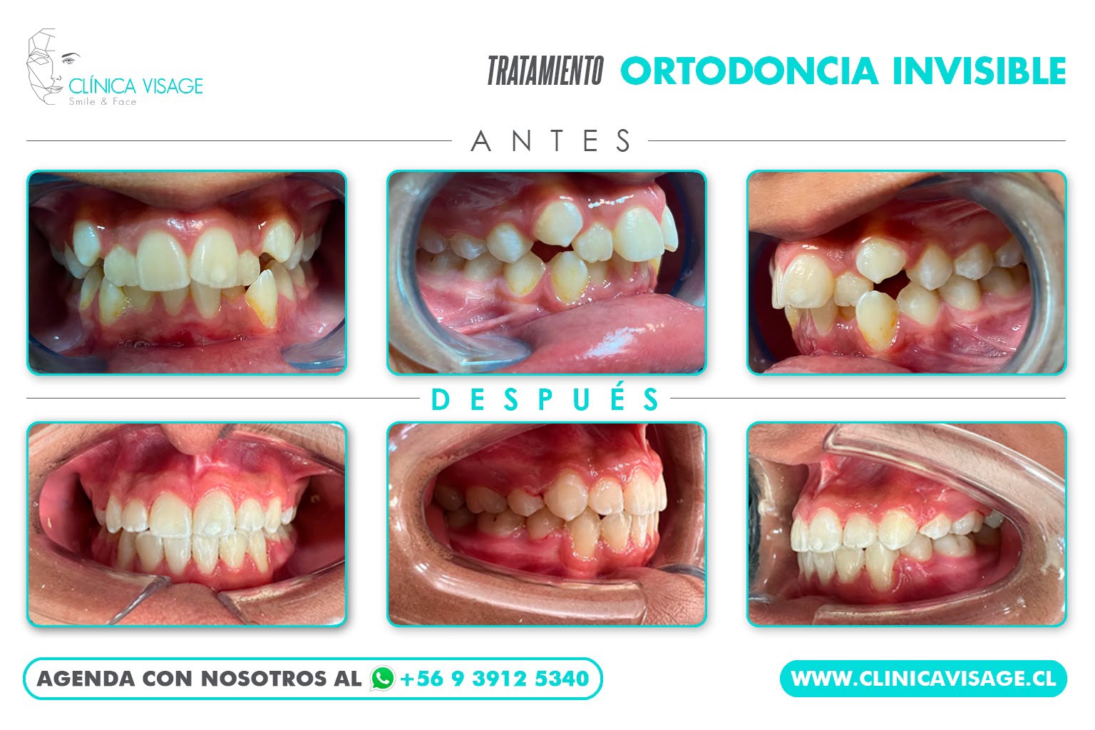 Antes y después de un caso de ortodoncia invisible en Clínica Visage