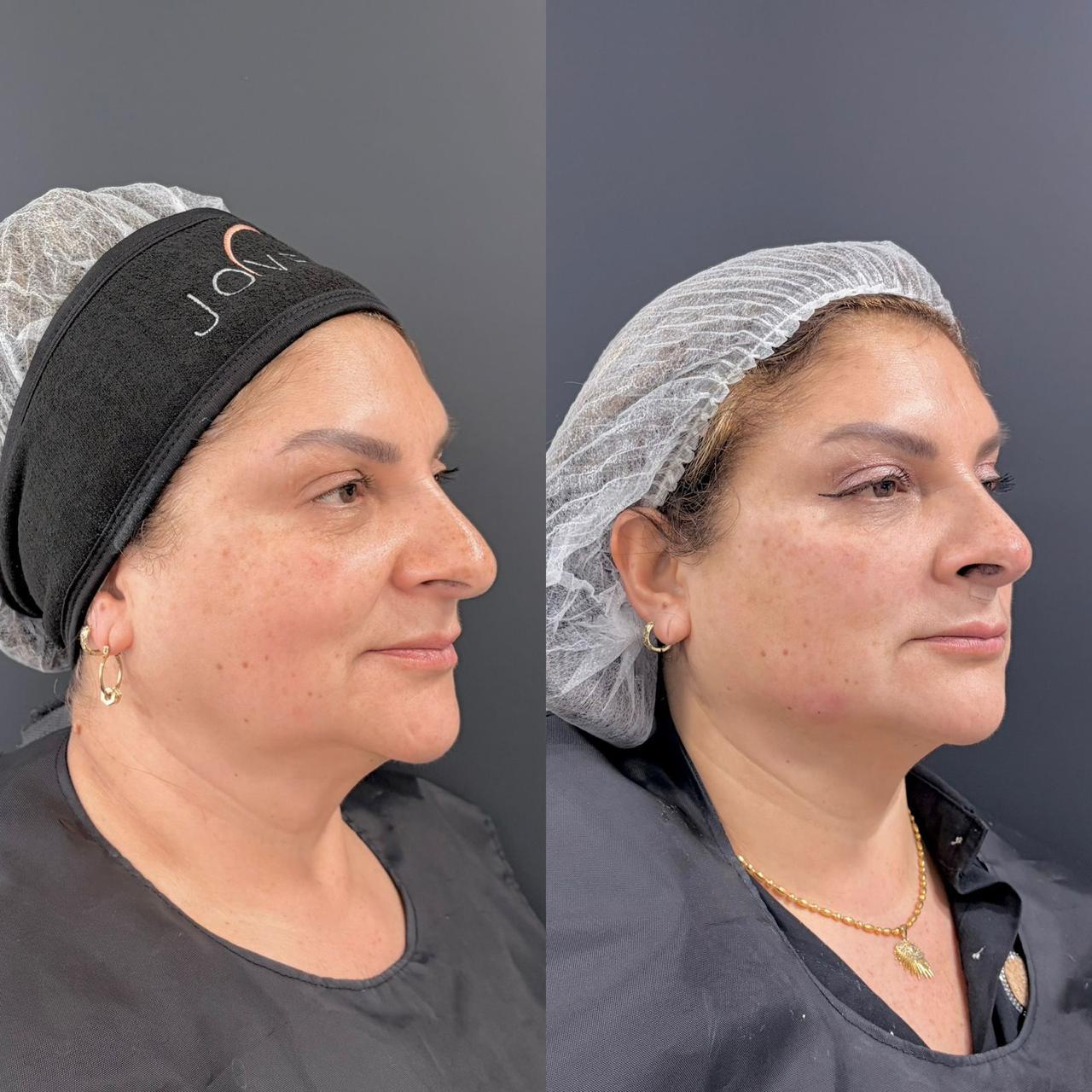 Antes y después de un paciente de Clínica Visage, caso 3