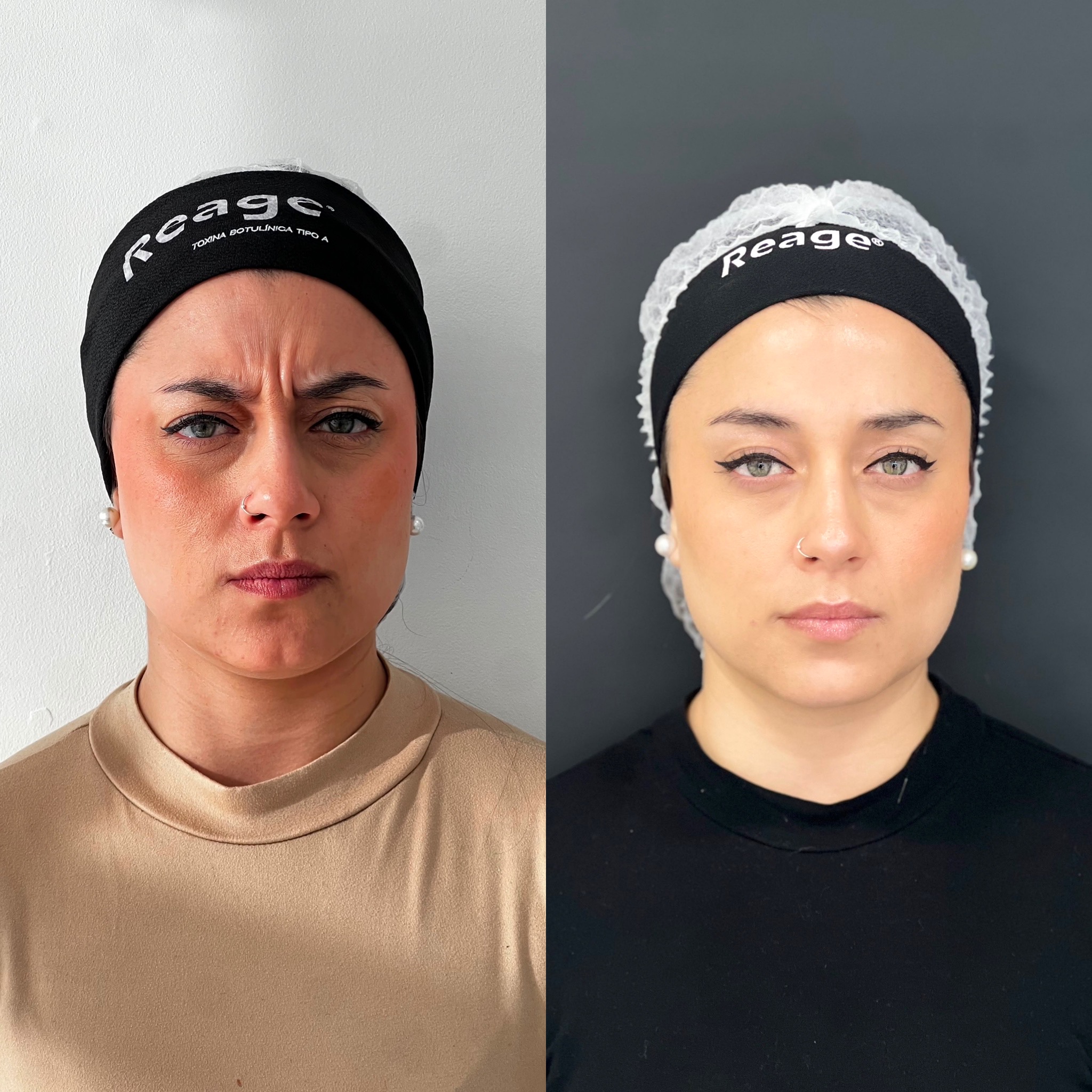 Antes y después de un paciente de Clínica Visage, caso 1