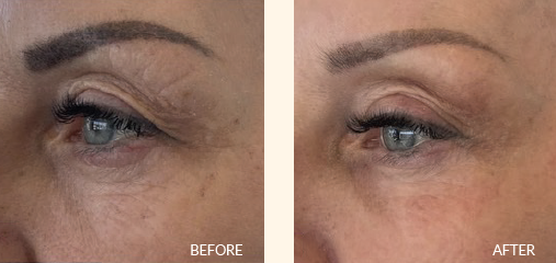 Tixel treatment before and after results showing improved skin texture and reduced fine lines