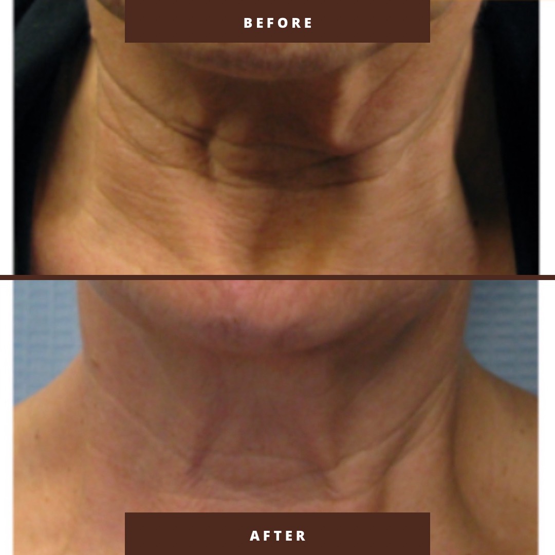 Tixel before and after patient result 5