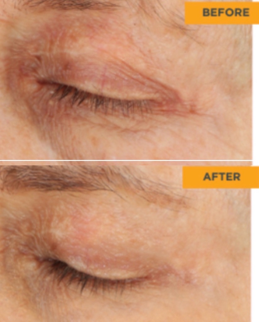 Tixel before and after patient result 3