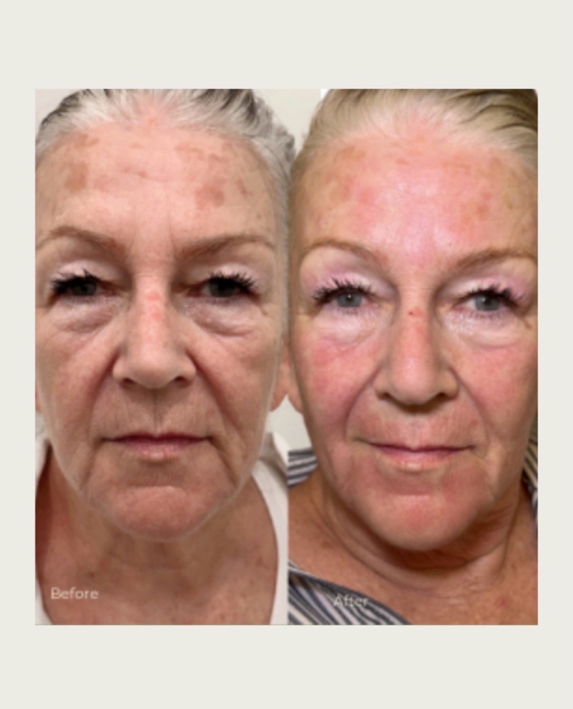 Tixel before and after patient result 1