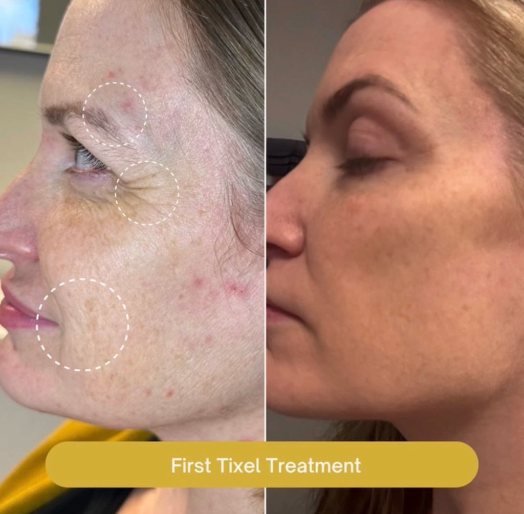 Tixel before and after patient result 2