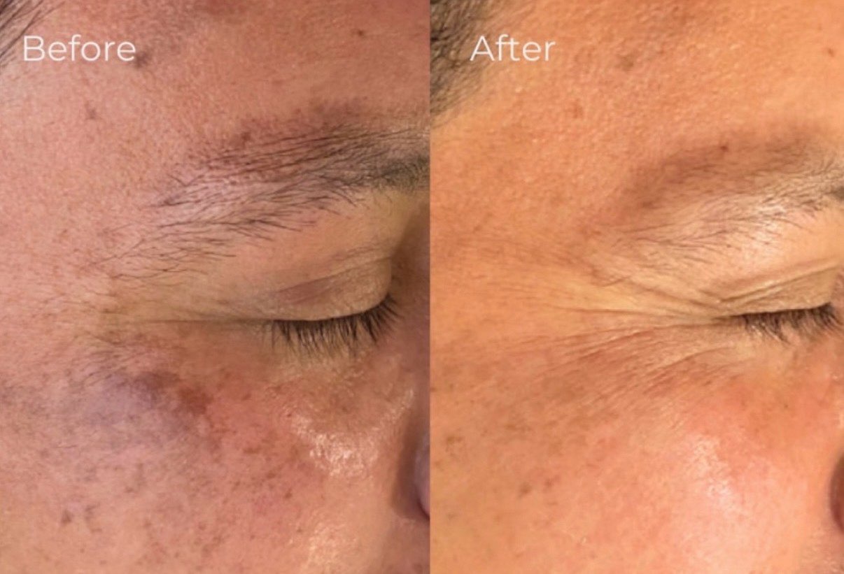Tixel before and after patient result 4