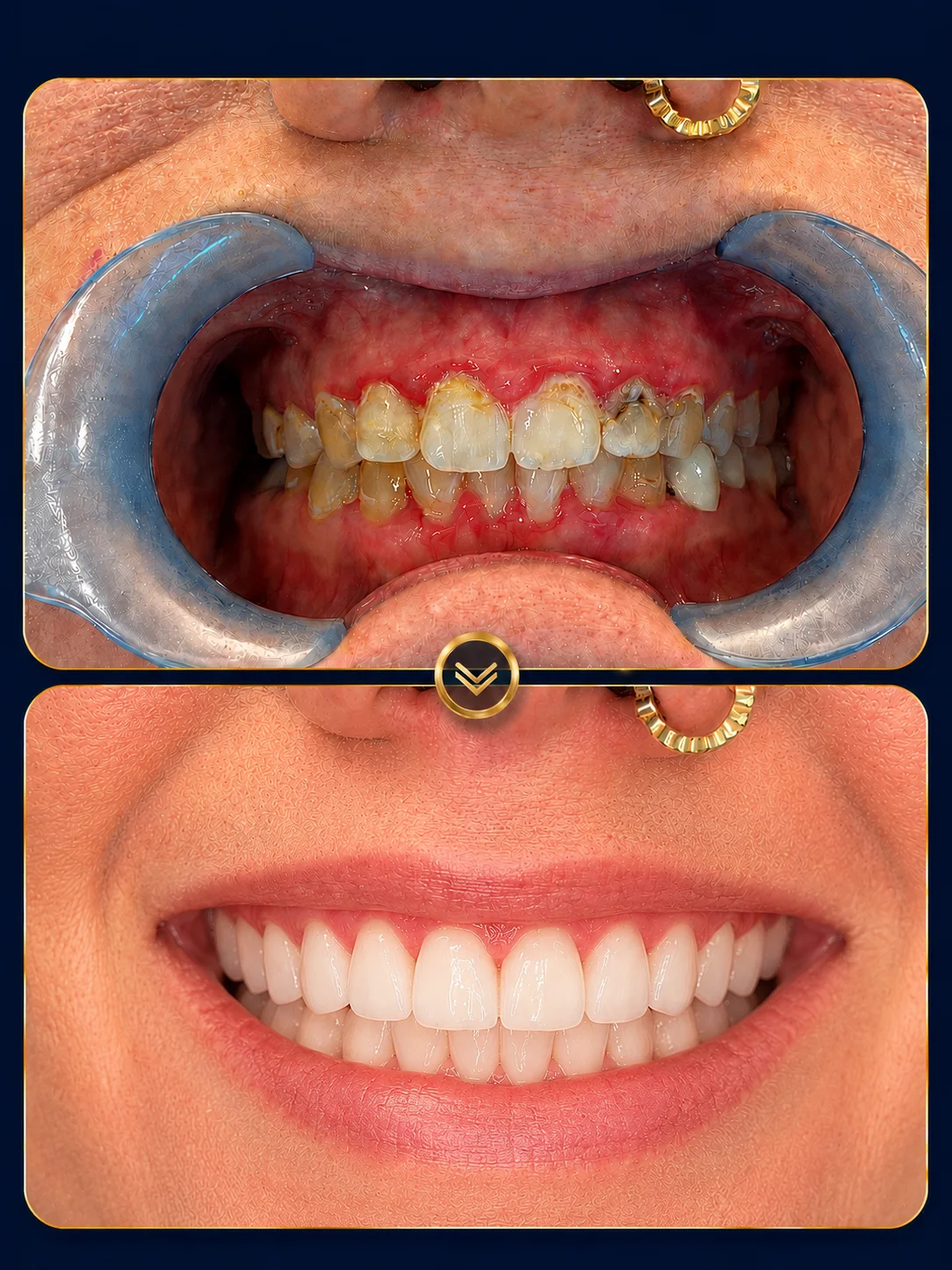 Before and After dental implants result 1