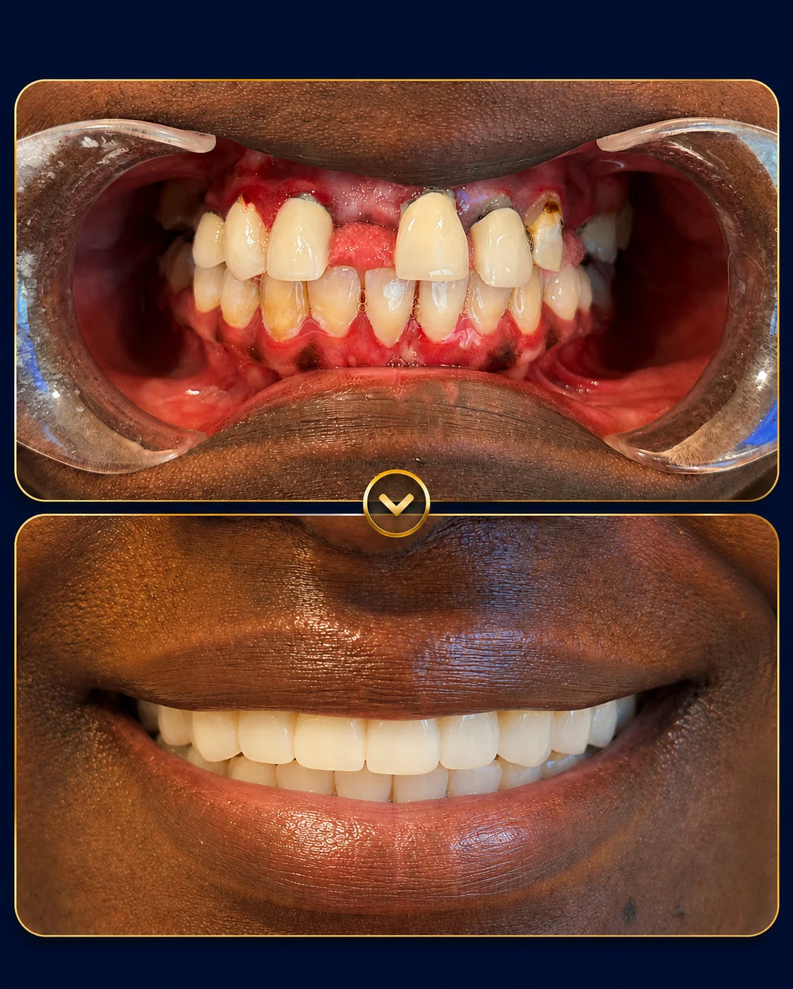 Before and After dental implants result 2