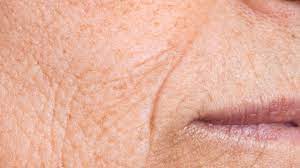 Dull complexion treatment