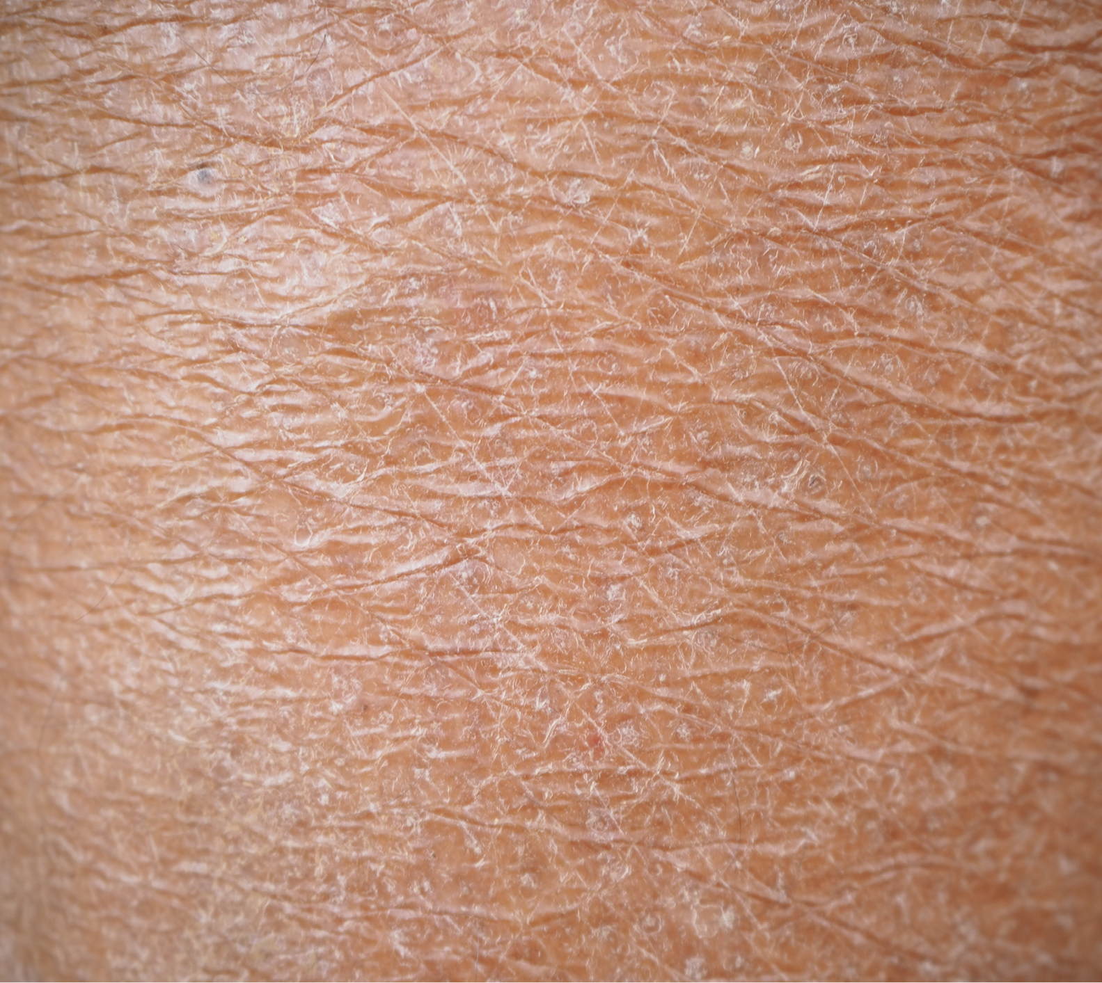 Dehydrated skin treatment