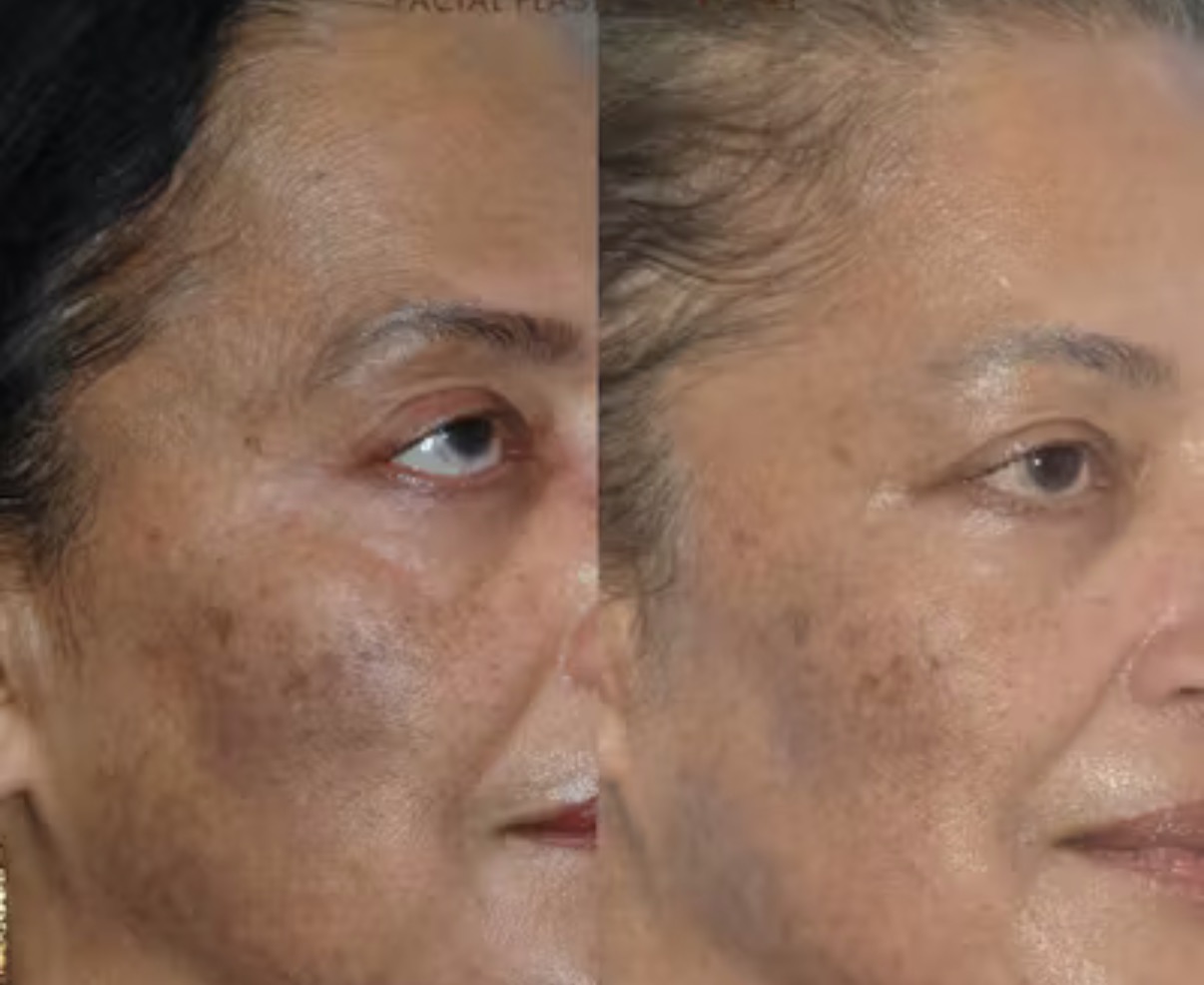 Treatment result