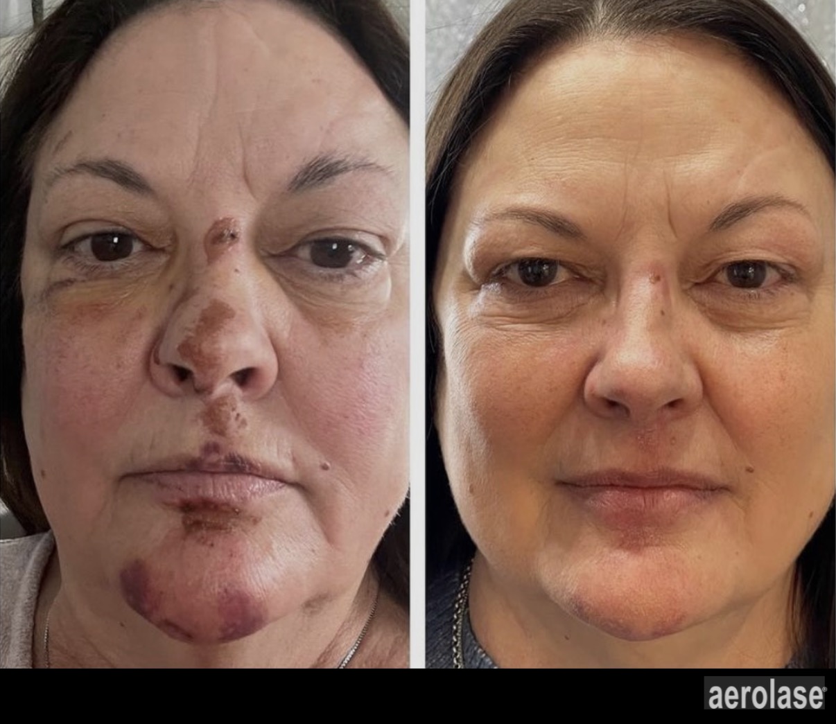Treatment result