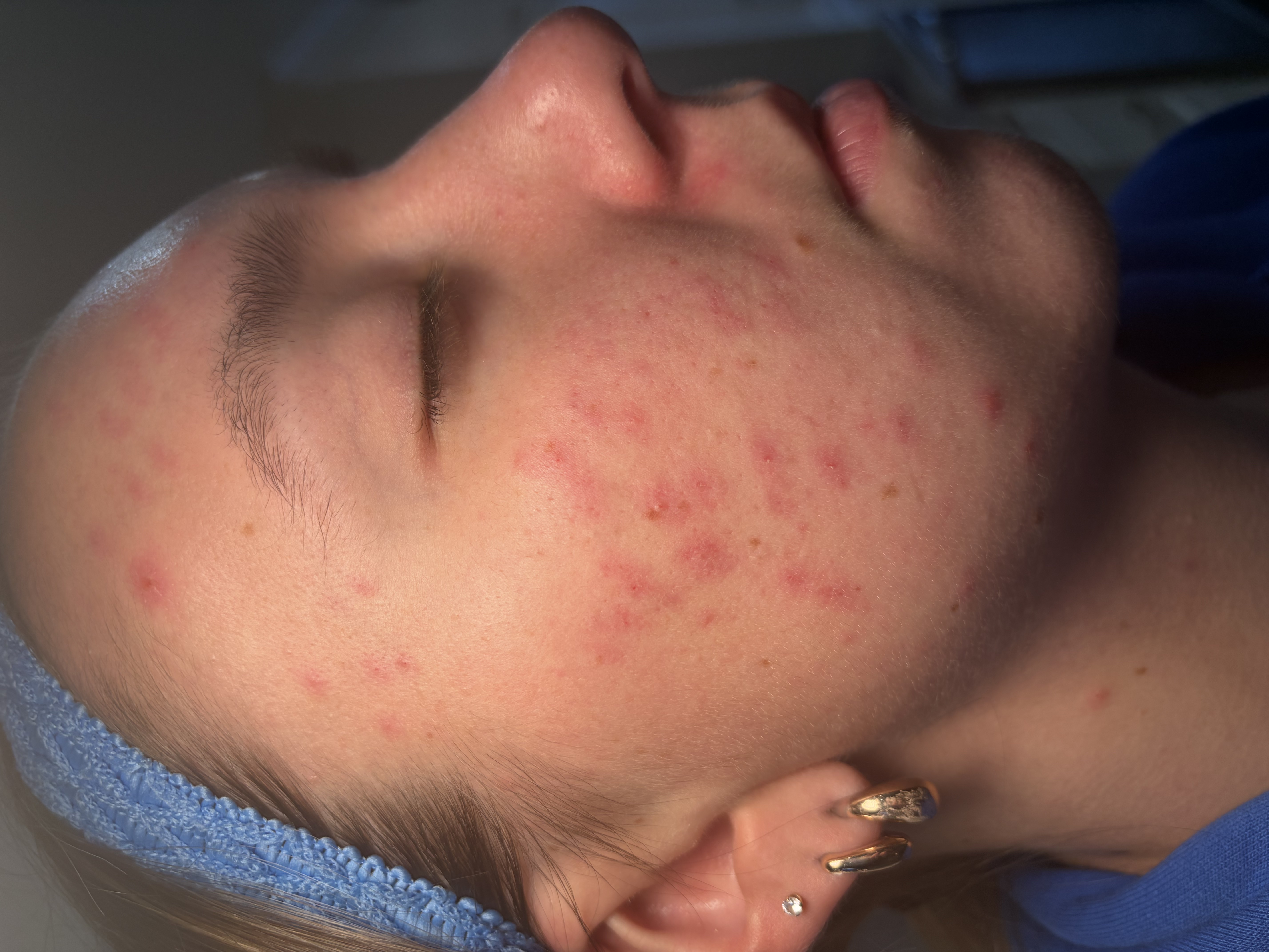 Before Aerolase treatment
