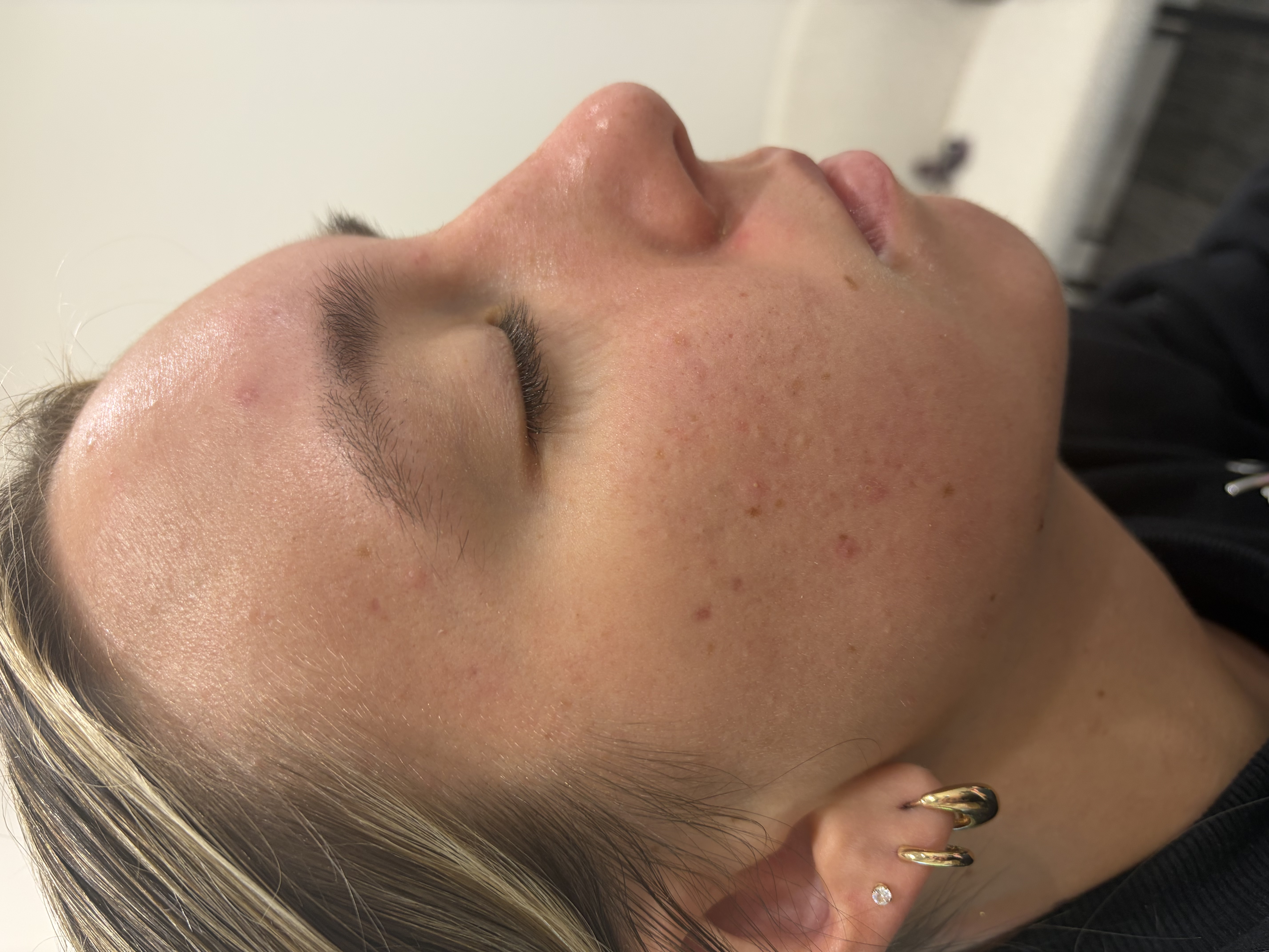 After Aerolase treatment