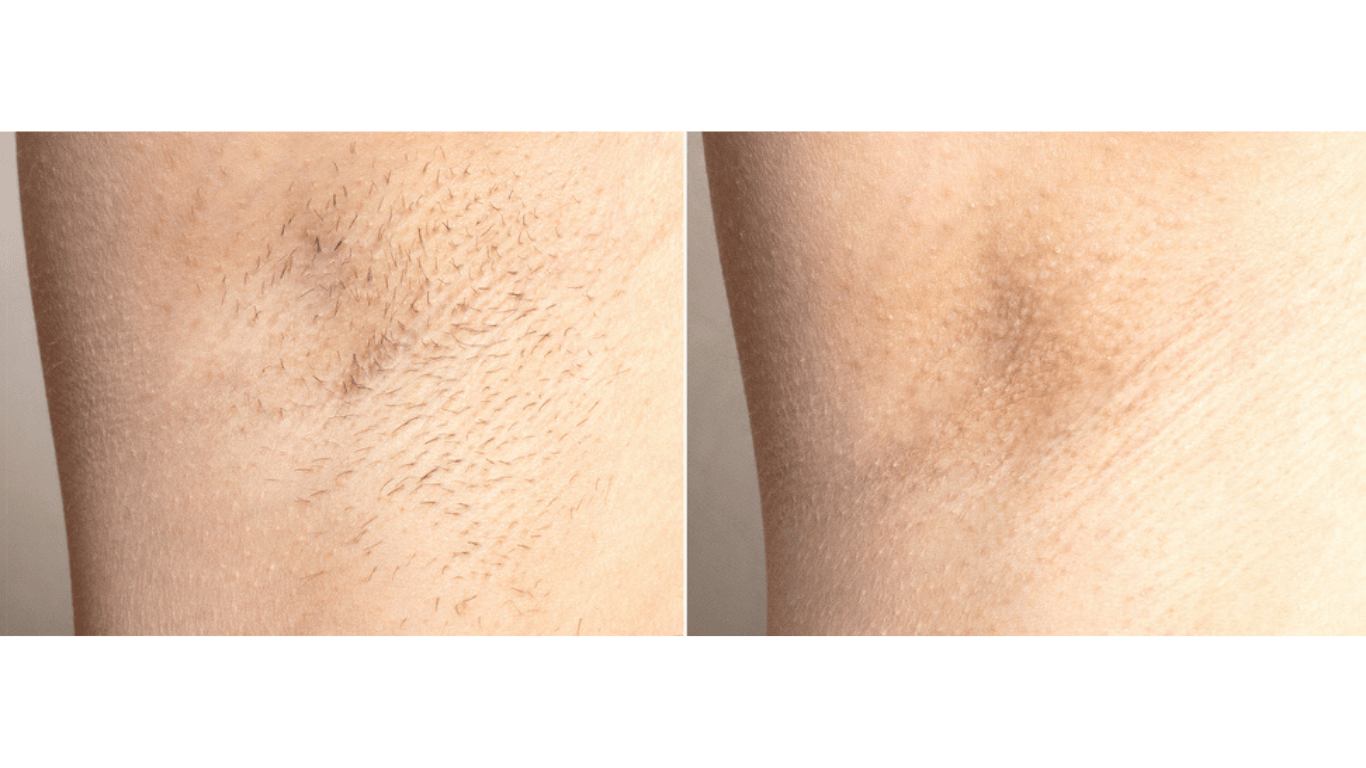 Nachher: Arm ohne Haare, glatte Haut, gleiche Perspektive, 3:2