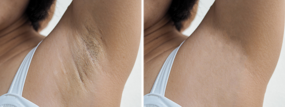 Vorher: Arm mit sichtbaren Haaren, natürliche Beleuchtung, 3:2