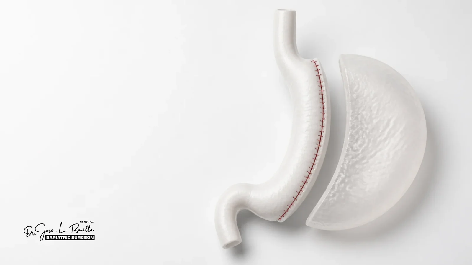 Modelo anatomico de una manga gastrica. Dr. José Luis Bonilla