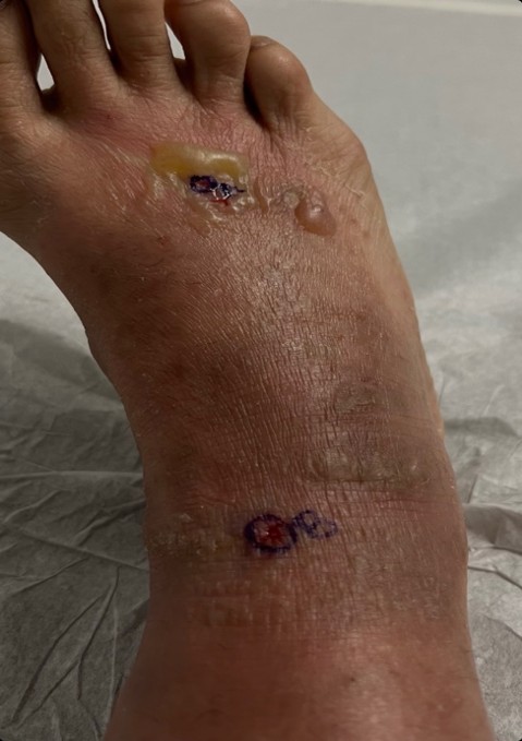 Before treatment — foot with open sores