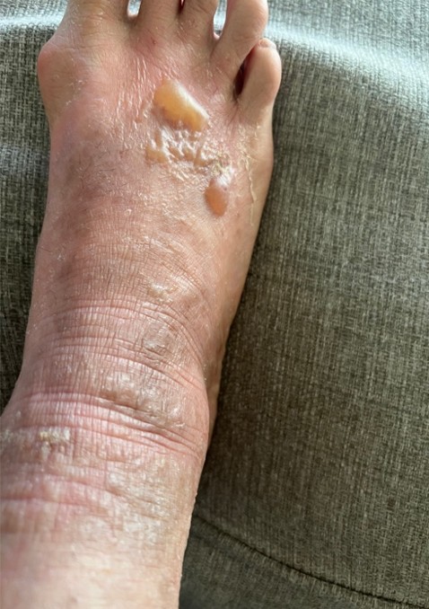 Before treatment — severe skin peeling
