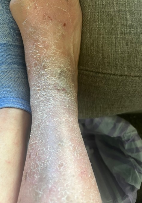 Mid treatment — skin beginning to heal
