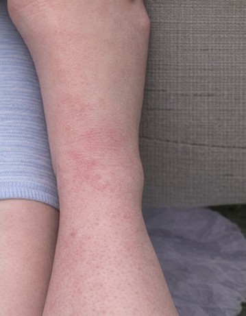 After treatment — dramatically healed skin