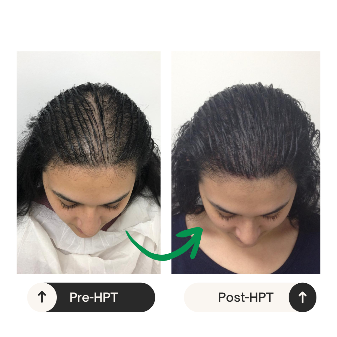 HPT Before and After