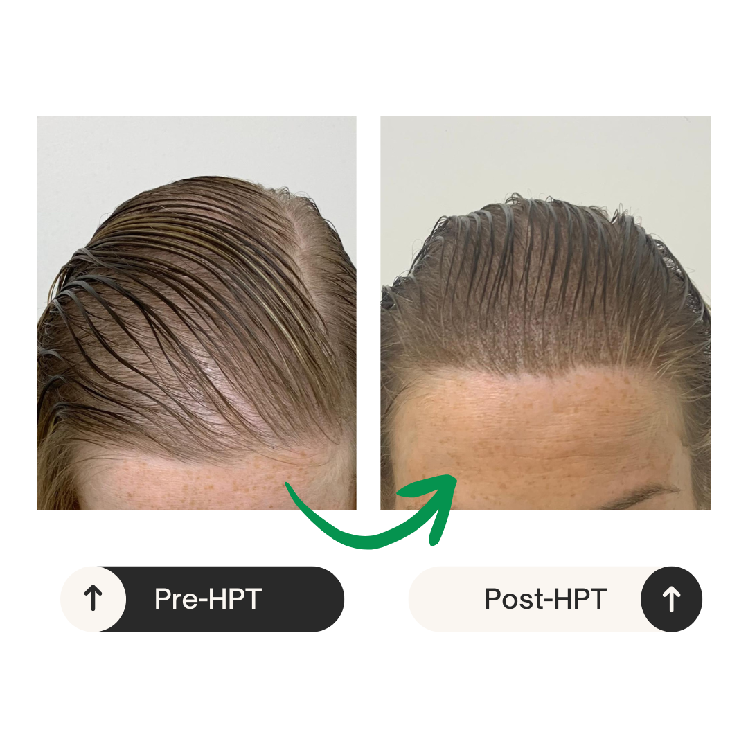 HPT Before and After