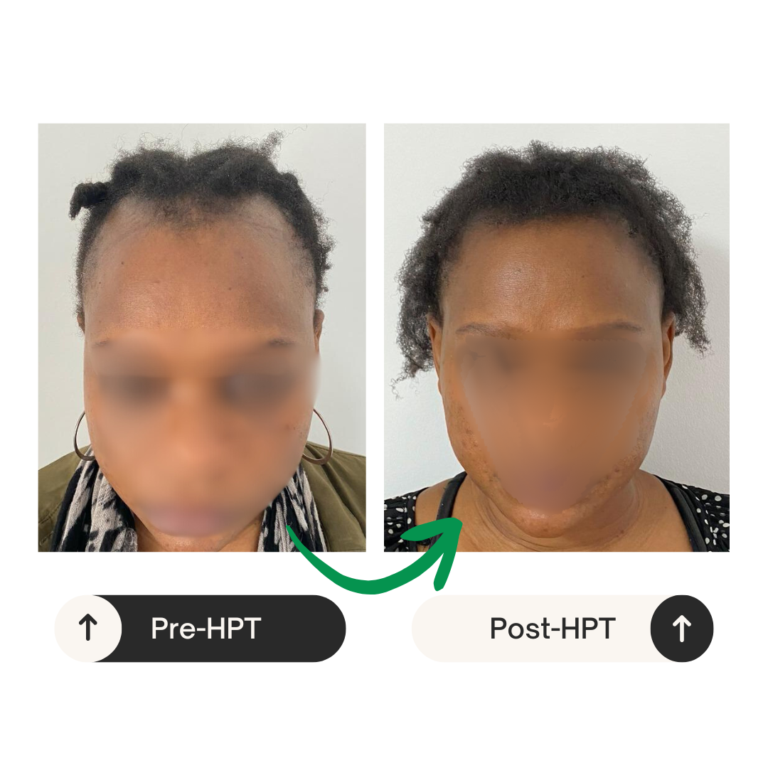 HPT Before and After