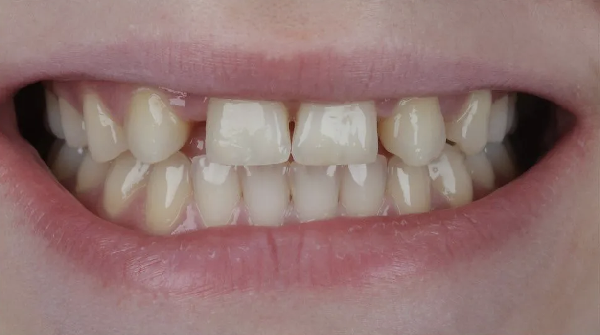 Before Invisalign treatment — patient 2