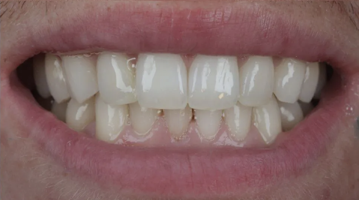 After Invisalign treatment — patient 4