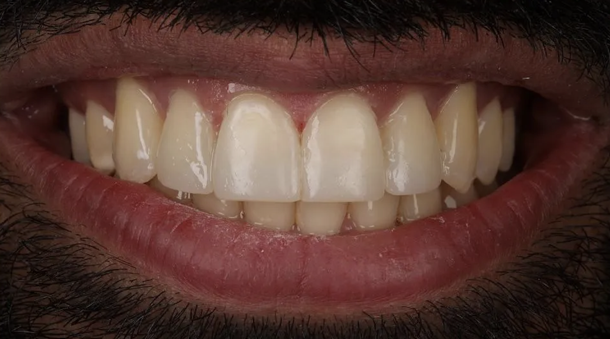 After Invisalign treatment — patient 3