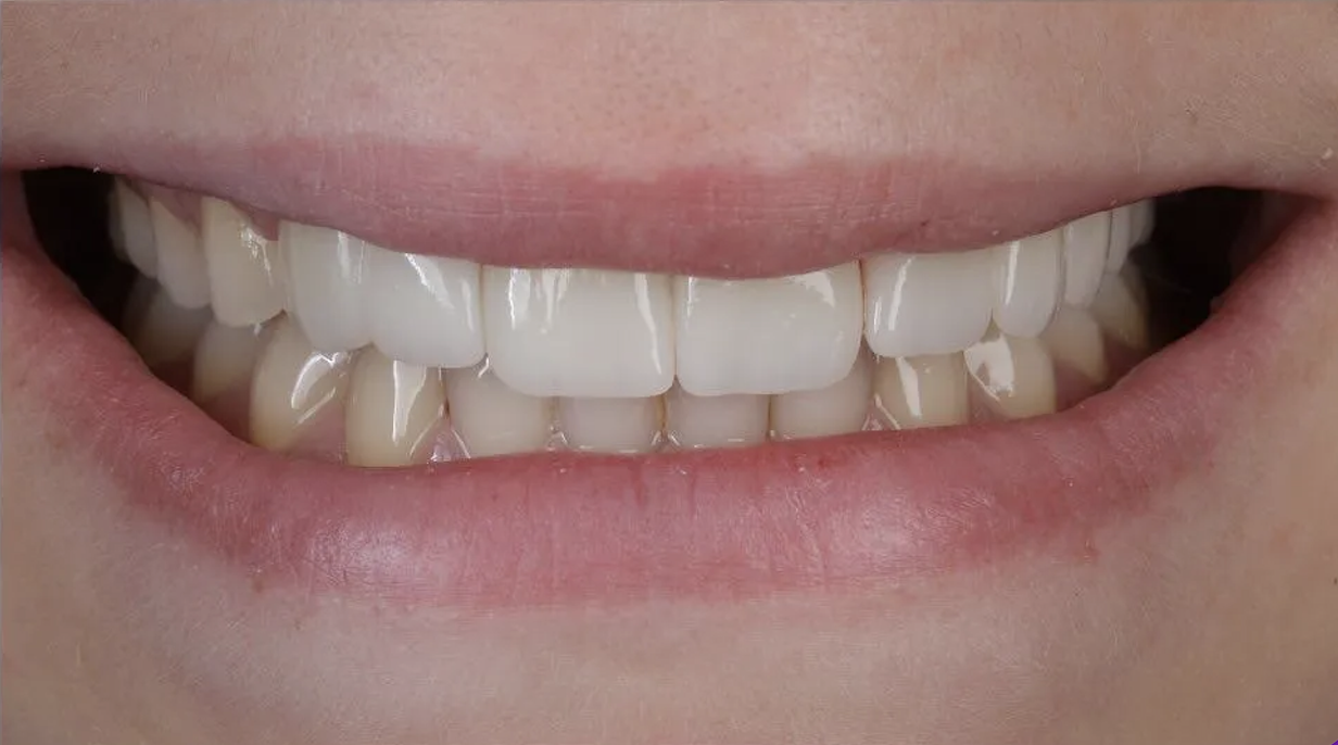 After Invisalign treatment — patient 2