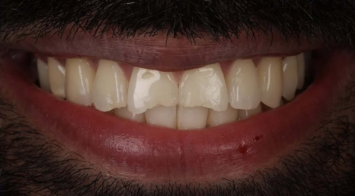 Before Invisalign treatment — patient 3