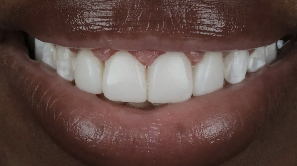 After Invisalign treatment — patient 1