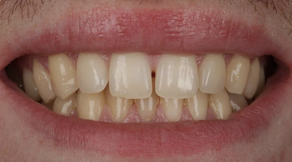 Before Invisalign treatment — patient 4