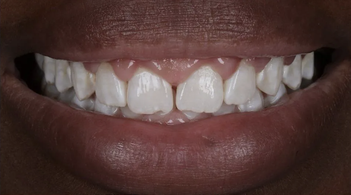 Before Invisalign treatment — patient 1