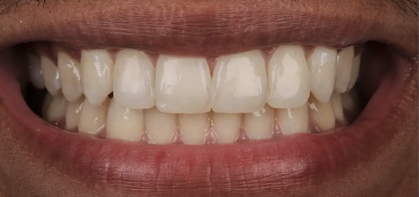 After composite bonding — Patient 1
