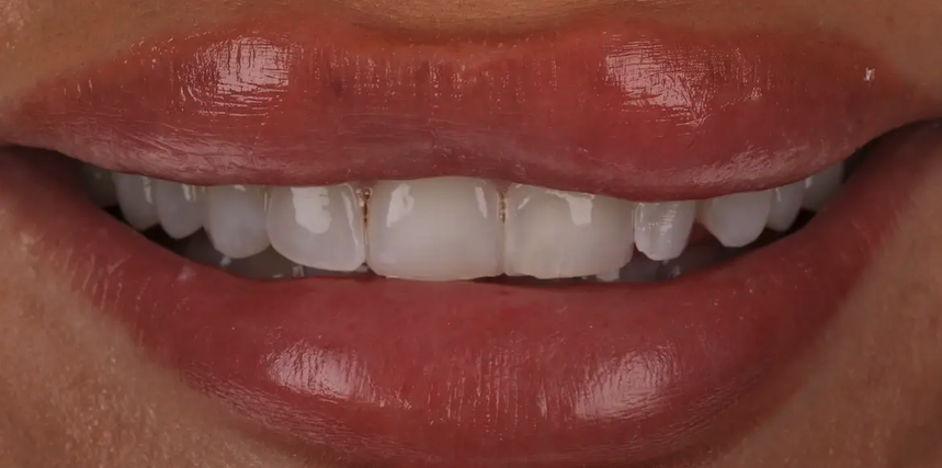 Before composite bonding — Patient 2