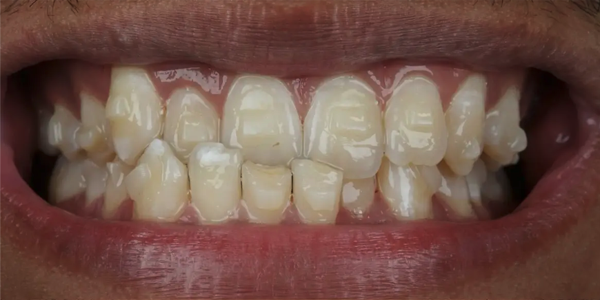 Before composite bonding — Patient 1