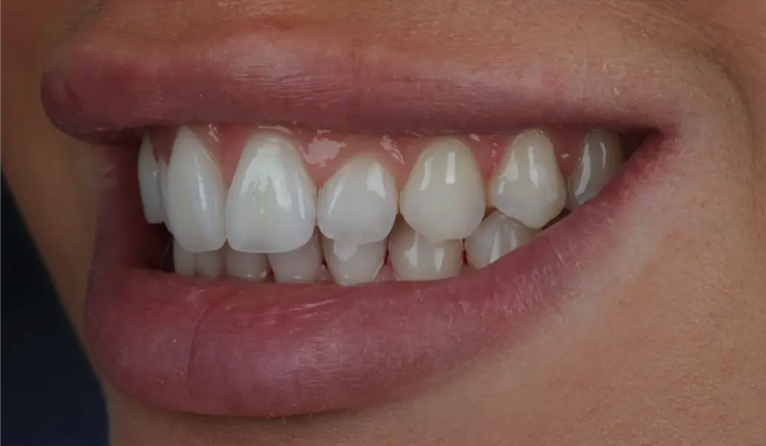 Before composite bonding — Patient 3