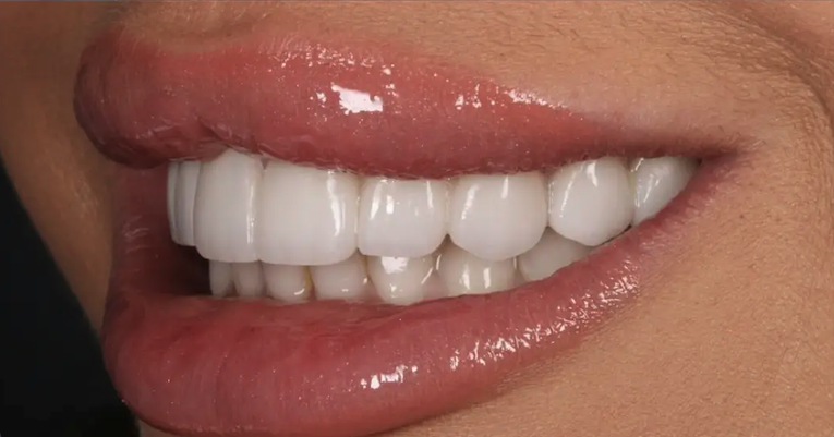 After composite bonding — Patient 3