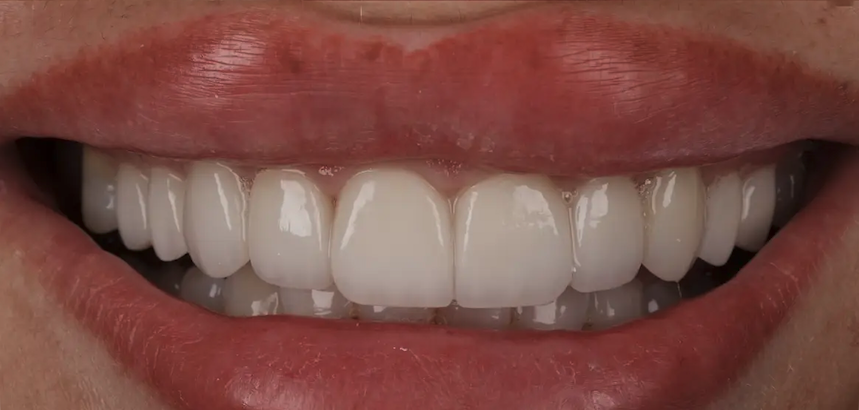 After composite bonding — Patient 2