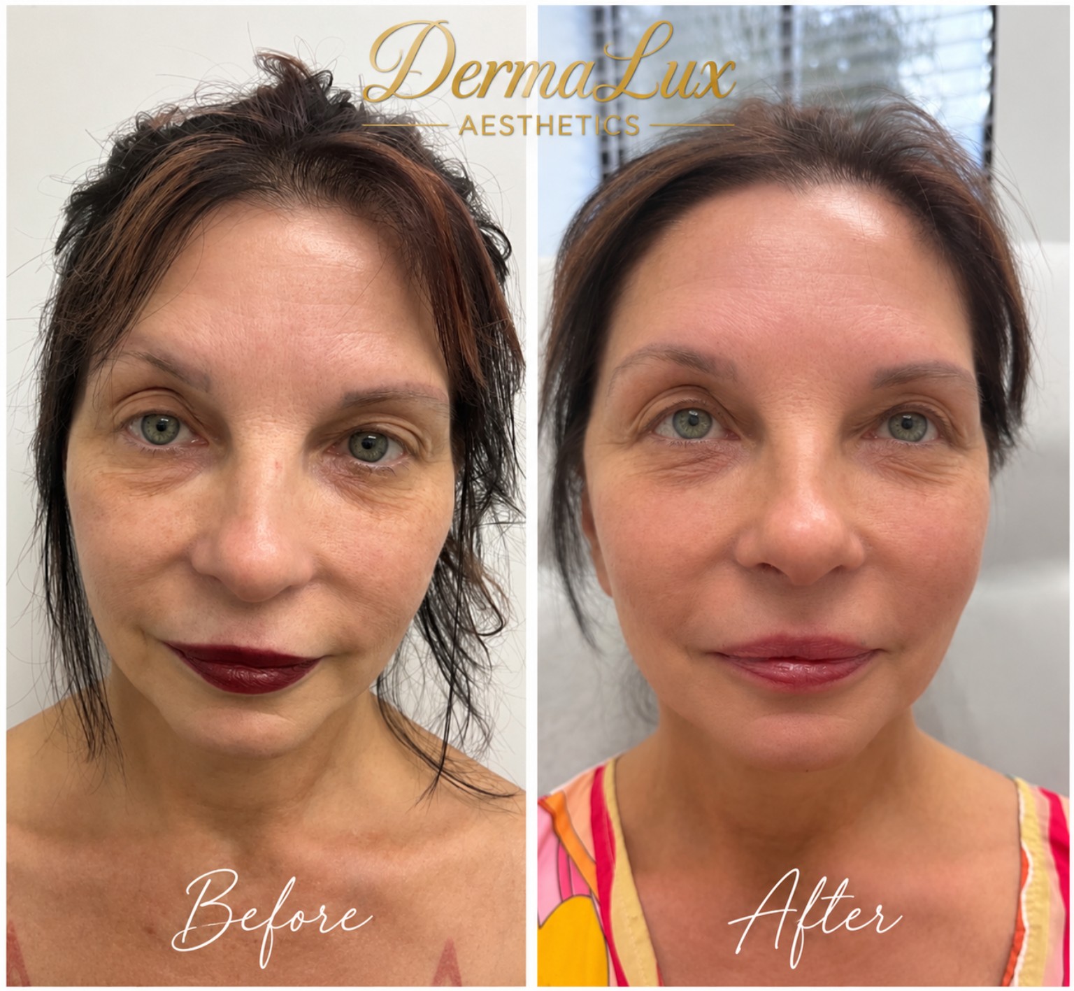 PDO thread lift before and after, front view